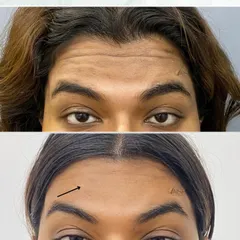 This before and after shows the significant reduction of deep horizontal lines on the forehead. The treatment relaxes the underlying muscles, resulting in a much smoother appearance.