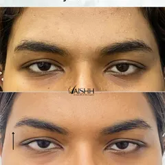 An often-overlooked benefit of treating frown lines is a subtle eyebrow lift. This opens up the eye area and contributes to a brighter, more refreshed look.