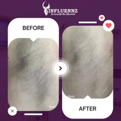 This image showcases the results of another successful underarm pigmentation treatment. The 'after' photo displays a much lighter and more uniform skin tone.