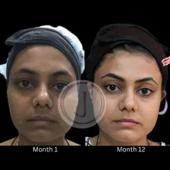 This year-long transformation shows the incredible impact of consistent medi-facials. We worked on exfoliating dead skin, infusing serums, and using laser toning to manage pigmentation, resulting in dramatically clearer and healthier skin.