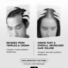 Here we illustrate the classic signs of DHT-related hair loss: a receding hairline and crown baldness in men, and a widening part with decreased volume in women. Early detection is key.