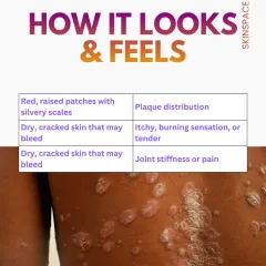 Psoriasis typically appears as red, raised patches with silvery scales, but it can also feel itchy or tender and cause joint stiffness. Recognizing these signs early is important for seeking timely medical care.