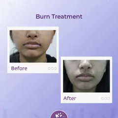 Treating burn scars requires a delicate and specialized approach to help the skin heal and regenerate. This image shows the significant improvement in skin texture and appearance following our advanced burn treatment protocol, which is personalized to each patient's recovery journey.