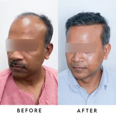 This transformation shows how we can turn back the clock on hair loss. By carefully reconstructing the hairline and adding density throughout, we achieve a result that is full, natural, and completely revitalizes our patient's look.