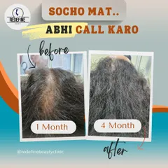 You don't always need surgery for great results. This is a four month transformation using our non-surgical GFC hair treatment. We used the power of his own growth factors to reduce hair fall and significantly improve hair density and thickness, especially in the crown area.