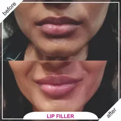 This before and after demonstrates a subtle yet impactful lip filler treatment. The goal was to enhance the natural shape, add hydration, and create a plumper, more balanced look that complements the client's features perfectly.