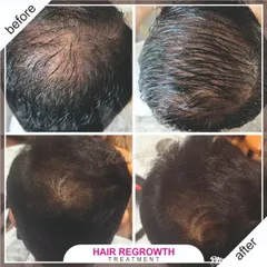 A comprehensive look at a male hair regrowth journey. These four photos document the progress from multiple angles, highlighting the return of both density and a stronger hairline.
