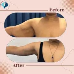 This before and after image shows the result of a brachioplasty, or arm lift. This procedure is designed to remove excess, sagging skin from the upper arms, creating a slimmer and more toned appearance.