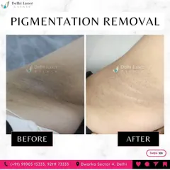 Dark underarms are a common concern, and this before-and-after shows the significant lightening we can achieve. Using targeted Q-Switch laser therapy, I can safely break down the pigmentation, resulting in clearer, more even-toned skin.