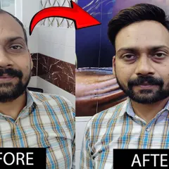 A front-on view of another successful hair transformation. We ensure the hair patch density and hairline match the client's face for a result that is both impressive and believable.