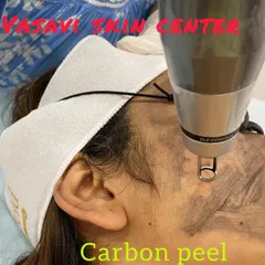 A close-up view of the Carbon Peel treatment. A layer of liquid carbon is applied to the skin, which penetrates deep into the pores. The laser is then used to vaporize the carbon particles, taking dead skin cells, contaminants, and oil with it.