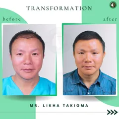 Mr. Likha Takioma's transformation is a perfect example of a successful hair restoration. The 'after' photo shows a natural, dense hairline that has completely changed his appearance and brought back his confidence.