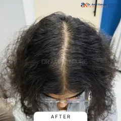 This is the 'after' photo of the same patient, showing a remarkable increase in density and a much narrower partition. This was achieved through a personalized treatment plan involving GFC and PRP therapy.