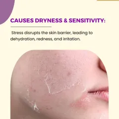 A compromised skin barrier is another side effect of chronic stress. This disruption leads to transepidermal water loss, causing dehydration, redness, and increased sensitivity.
