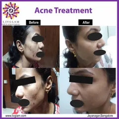 This client's journey shows a successful outcome from our comprehensive acne treatment plan. The 'after' photos display a significant clearing of active acne and a reduction in post-inflammatory hyperpigmentation.
