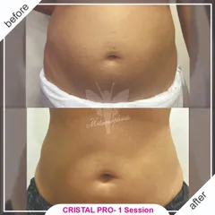 A significant reduction in abdominal fat and a more contoured waistline after a single session with Cristal Pro. This before and after photo demonstrates the power of cryolipolysis for targeted, non-surgical fat removal.