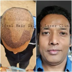This image documents the FUE transplant progress, from the day of the procedure with newly implanted grafts to the final, impressive hair growth.