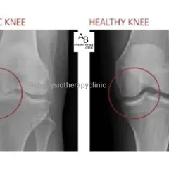 This X-ray comparison clearly shows the difference between a healthy knee joint and one affected by arthritis. You can see the reduced joint space, which is a common cause of pain, stiffness, and reduced mobility that we treat.