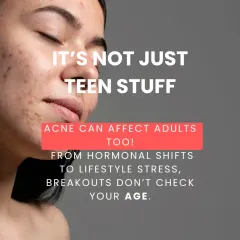 Breakouts do not check your age. I see many adults, especially women, who are dealing with acne for the first time or have persistent issues due to hormonal shifts and lifestyle stress. My clinic offers advanced solutions for adult acne.