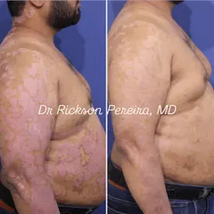 Another angle of the same patient, highlighting the extensive clearance of psoriasis on the arm and torso. Modern biologics are life-changing, offering a safer and more effective alternative to older systemic drugs for long-term management.