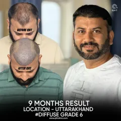 This is a clear look at a 9-month transformation for a patient with Diffuse Grade 6 baldness. Using 4500 grafts, I reconstructed his hairline and restored density to the mid-scalp and crown, achieving a full and natural appearance.