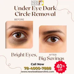 This before and after comparison highlights our success in treating one of the most common concerns: under-eye dark circles. The result is a brighter, more refreshed appearance, achieved through a personalized treatment plan designed to restore skin tone and texture.