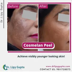 Here you can see the powerful results of a Cosmelan Peel. This medical-grade treatment is one of my go-to solutions for stubborn pigmentation and melasma. Notice the significant reduction in dark spots and the overall improvement in skin clarity and texture, revealing visibly brighter and more even-toned skin.