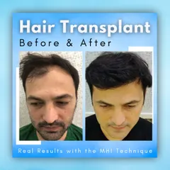 Real results achieved with our signature MHI technique. Notice the natural density and the well-designed hairline that frames the face, creating a more youthful and confident appearance.