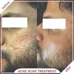 This before-and-after shows the result of targeting stubborn acne scars. Our combination treatments help rebuild collagen and significantly improve skin texture and smoothness.