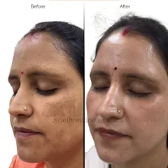 Another angle showcasing the successful melasma treatment. Notice the restored clarity and smooth texture of the skin, highlighting the effectiveness of a customized, professional-grade facial plan.