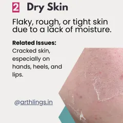 Dry skin feels flaky, rough, or tight due to a lack of moisture. This can lead to cracked skin, especially on the hands, heels, and lips.