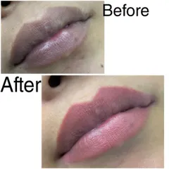This is the healed result of a lip blush treatment after two sittings. The color settles into a gorgeous, soft tint that enhances the natural shape and makes the lips look fuller and more vibrant.