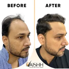 This patient's result highlights the power of a well-executed hair transplant. We restored his receding hairline and added density throughout the frontal region, achieving a much more youthful appearance.