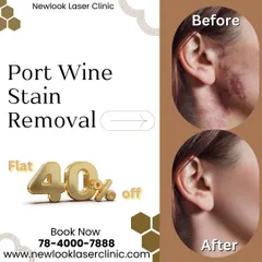 This before and after result for a port wine stain on the side of the face shows a remarkable transformation. We focus on achieving a natural-looking outcome, helping clients feel more comfortable and confident in their appearance.