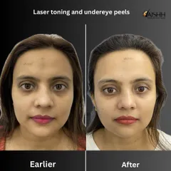 This patient's transformation was achieved over three months with a combination of laser toning for overall facial pigmentation and targeted under-eye peels to address dark circles, resulting in a brighter and more refreshed appearance.