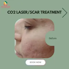 This is the "before" stage of a CO2 laser scar treatment. It shows the texture and depth of acne scarring that I can effectively address with advanced laser resurfacing.