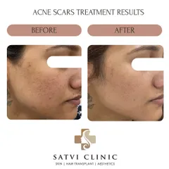Here, you can see the visible fading of deep-set acne scars and a more even skin tone. I use a combination of advanced treatments like Fractional CO₂ Laser and Microneedling RF, tailored to each patient's specific scar type.