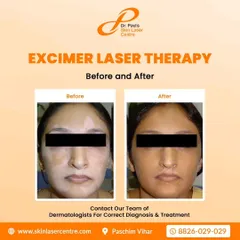 This patient saw a significant restoration of skin color on her face after undergoing Excimer laser therapy. This treatment is highly effective for targeting specific, stubborn patches of vitiligo by using a focused beam of light to stimulate repigmentation.