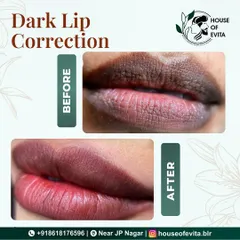 This is a life-changing Dark Lip Correction. I carefully neutralized the cool, dark tones to reveal a brighter, more even, and naturally rosy color. This semi-permanent treatment eliminates the need for constant lipstick application.