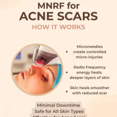 This graphic explains how MNRF for acne scars works. Microneedles create controlled micro-injuries while radiofrequency energy heats deeper skin layers, causing the skin to heal smoother with reduced scarring.