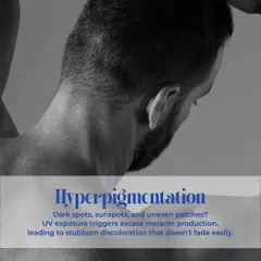 One of the most common signs of sun damage is hyperpigmentation. UV exposure triggers excess melanin production, leading to dark spots, sunspots, and uneven patches that don't fade easily on their own.