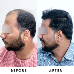This side profile highlights the restored temple points and the seamless transition from the new hairline to the existing hair.
