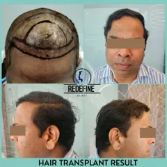 A successful hair transplant is a team effort. Here you can see the planning stage, where we map out the new hairline, and the final result. We ensure every graft is placed meticulously for a dense, natural look that lasts a lifetime.
