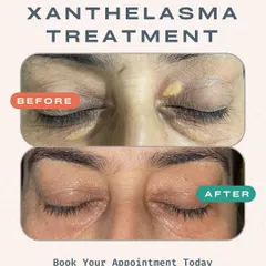This transformation shows the successful treatment of Xanthelasma, the yellowish deposits around the eyes. Our non-surgical method completely clears these deposits, restoring a smooth and even appearance to the delicate eye area.