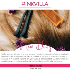 In this article, I discuss the causes of scalp acne, which can range from clogged pores to bacterial growth. Understanding the root cause is essential for finding the right treatment and preventing future breakouts.