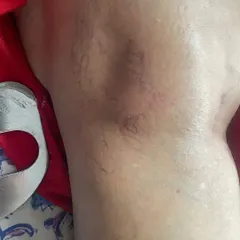 This is the leg after completing a course of our tailored physiotherapy. The improvement is clear, with a dramatic reduction in the appearance of the varicose veins.