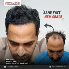 Same face, new grace. This is a one year result after a 3000 graft B.E.S.T. FUE transplant. The transformation highlights the significant improvement in density and the natural design of the restored hairline.