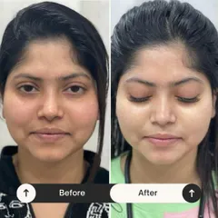 This before and after is a perfect example of the rejuvenating power of my Miracle Facial. Her skin looks brighter, smoother, and more rested. It's the perfect treatment to reset your skin and bring back its natural radiance.