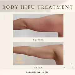 HIFU is not just for the face. This client was concerned about sagging skin on her arms, and after a course of Body HIFU sessions, her arms are visibly firmer and more toned.