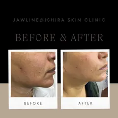 A well-defined jawline can transform your entire profile. Here, I used dermal fillers to sculpt the jawline and correct drooping at the corners of the mouth, creating a sharper and more youthful contour.